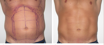 25-34 year old man treated with Vaser Liposuction before 4599304