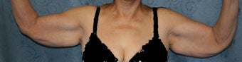 Arm Lift 1029361