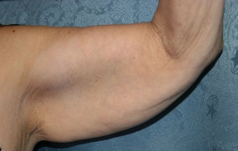 Arm Lift before 1029361