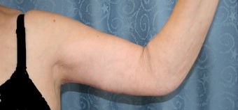 Arm Lift after 1029361