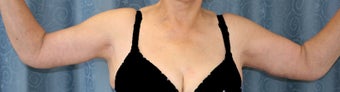 Arm Lift 1029361