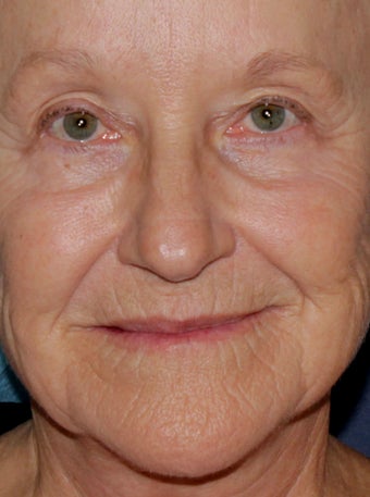 67 year old woman treated to wrinkles around mouth, texture issues with Fraxel repair and other lasers before 1245184