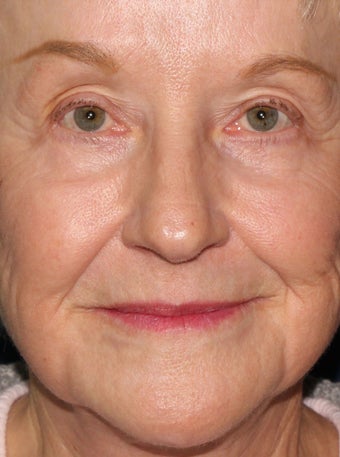 67 year old woman treated to wrinkles around mouth, texture issues with Fraxel repair and other lasers after 1245184