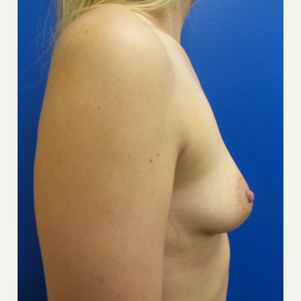 25-34 year old woman treated with Breast Augmentation before 3781548