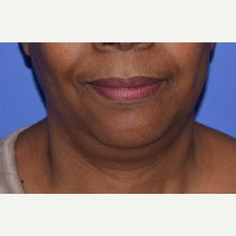 55-64 year old woman treated with Chin Liposuction before 3638236