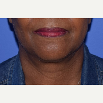 55-64 year old woman treated with Chin Liposuction after 3638236