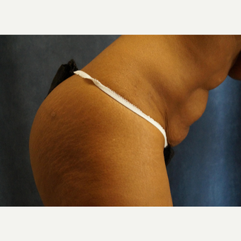 35-44 year old woman treated with Tummy Tuck before 3704089