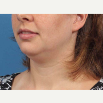 25-34 year old woman treated with Chin Liposuction before 3787638