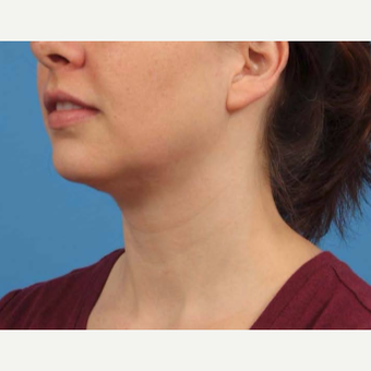 25-34 year old woman treated with Chin Liposuction after 3787638