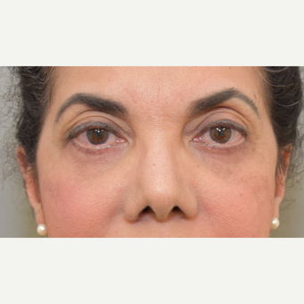 61 year old woman treated with Eye Bags Treatment after 3259435