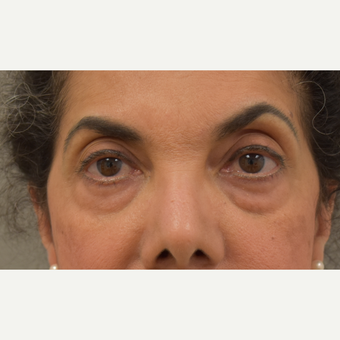 61 year old woman treated with Eye Bags Treatment before 3259435