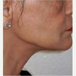 45-54 year old woman treated with Facelift after 3500844