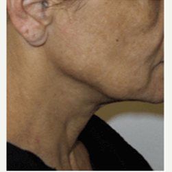 45-54 year old woman treated with Facelift before 3500844