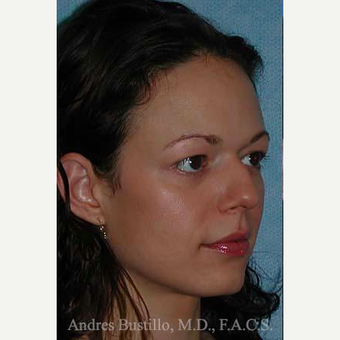 25-34 year old woman treated with Rhinoplasty before 3460987