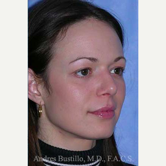 25-34 year old woman treated with Rhinoplasty after 3460987
