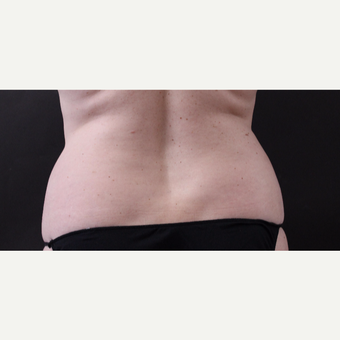 46 year old woman treated with CoolSculpting after 3168898