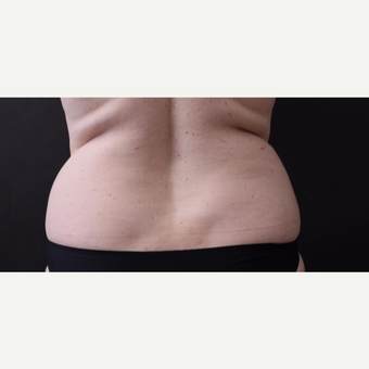 46 year old woman treated with CoolSculpting before 3168898