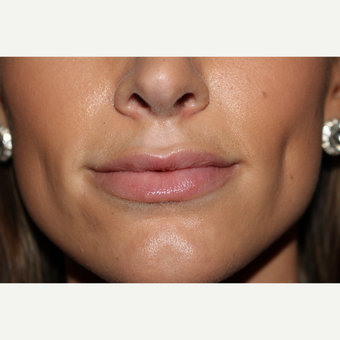 25-34 year old woman treated with Juvederm after 3130055
