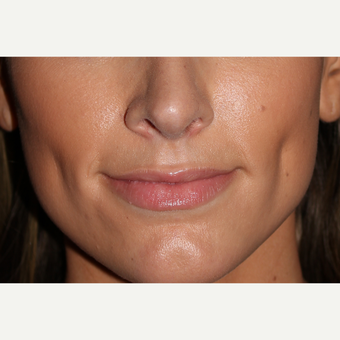25-34 year old woman treated with Juvederm before 3130055