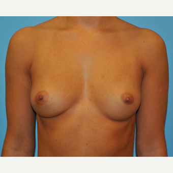 28 year old woman treated with Breast Augmentation, B to DD cup before 3493907