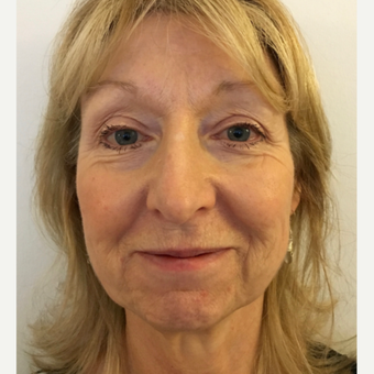 Lower face and neck lift before 3112423