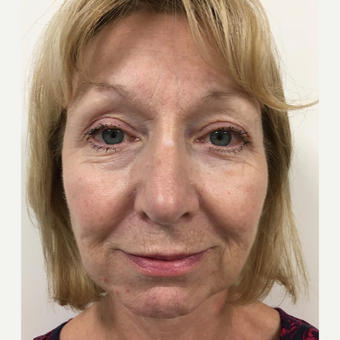 Lower face and neck lift after 3112423