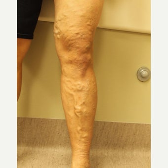 45-54 year old woman treated with ClariVein before 2081407