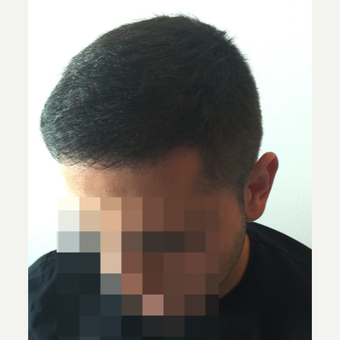 26 years old man treated with FUE Hair Transplant after 3068889