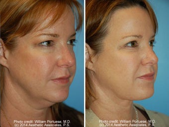 Neck Liposuction before 1389488