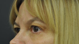 54 Year Old Woman Treated for Fine Lines Under Eyes With Exilis Elite after 1263333