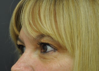 54 Year Old Woman Treated for Fine Lines Under Eyes With Exilis Elite before 1263333