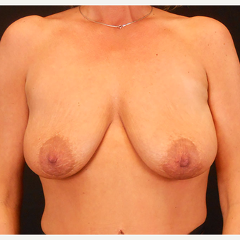 35-44 year old woman treated with Breast Lift with Implants before 3203244