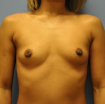 Breast Augmentation, Breast Implants before 1224619