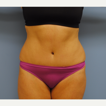 48 year old woman treated with Tummy Tuck after 3208141