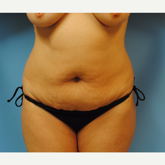 48 year old woman treated with Tummy Tuck before 3208141