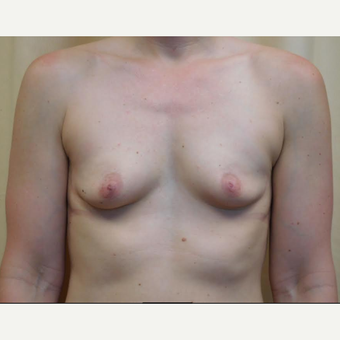 35-44 year old woman treated with Breast Augmentation before 3683315