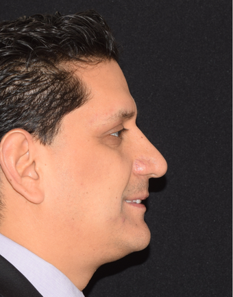 35-44 year old man treated with Chin Liposuction after 1782653