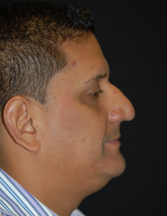 35-44 year old man treated with Chin Liposuction before 1782653