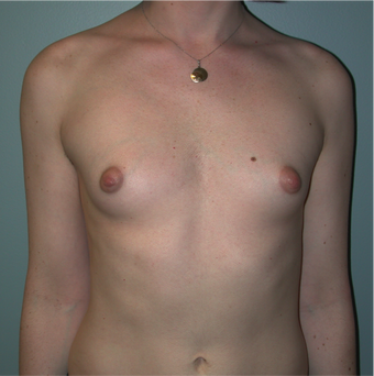 Young Woman Undergoes Breast Augmentation as part of Male to Female Gender Transformation before 1190955