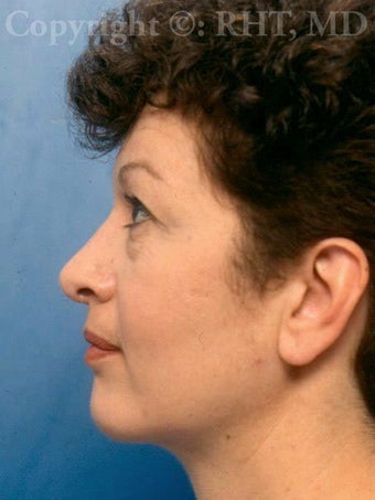 Rhinoplasty; chin implant after 259385