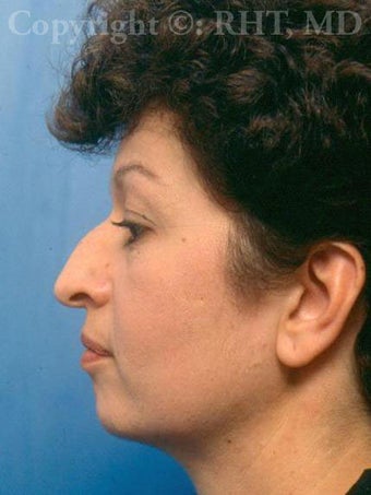 Rhinoplasty; chin implant before 259385