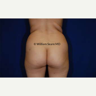 35-44 year old woman treated with Fat Transfer before 3777840