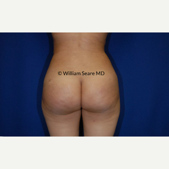 35-44 year old woman treated with Fat Transfer after 3777840