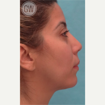 25-34 year old woman treated with Nose Surgery before 3477990