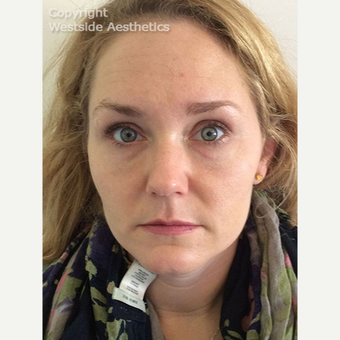 Non Surgical Under Eye Bag Treatment after 2960550