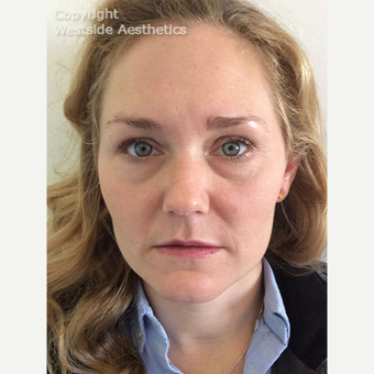 Non Surgical Under Eye Bag Treatment before 2960550