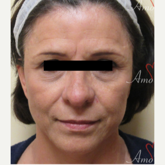 45-54 year old woman treated with Restylane before 3835964