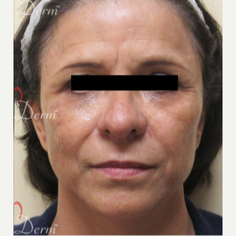 45-54 year old woman treated with Restylane after 3835964