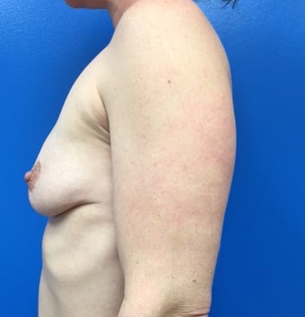 35-44 year old woman treated with Breast Implants 2213389