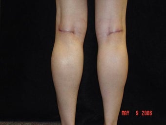 Calf Implants 692868